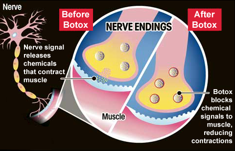 how botox works - بوتاکس چگونه کار می کند و اعصاب را از کار می اندازد
